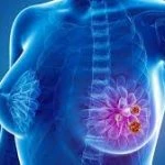 Câncer de mama: sintomas, tratamentos, causas e prevenção